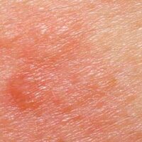 Allergic complaints? Not just Histamine.