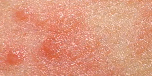 histamine-gevoeligheid